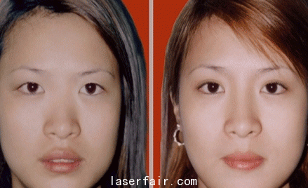 南京欧华大s美白针有副作用吗